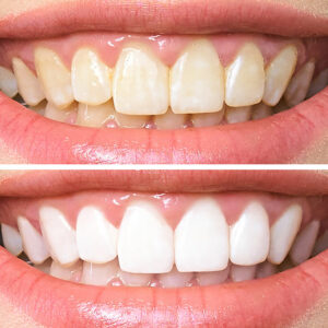 Avoid these 7 common teeth whitening mistakes