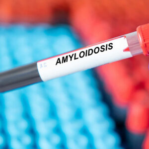 9 early warning signs of amyloidosis to know of